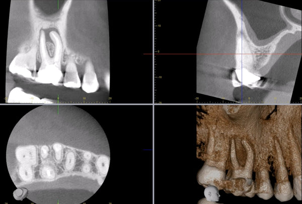 CBCT Course- Level 1 & 2 with emphasis on Endodontics- June 2025