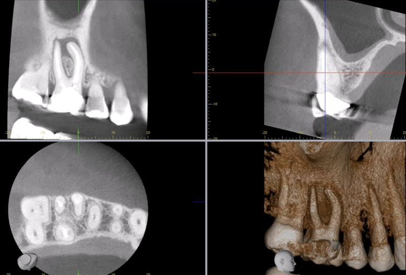 CBCT Course- Level 1 & 2 with emphasis on Endodontics- June 2025