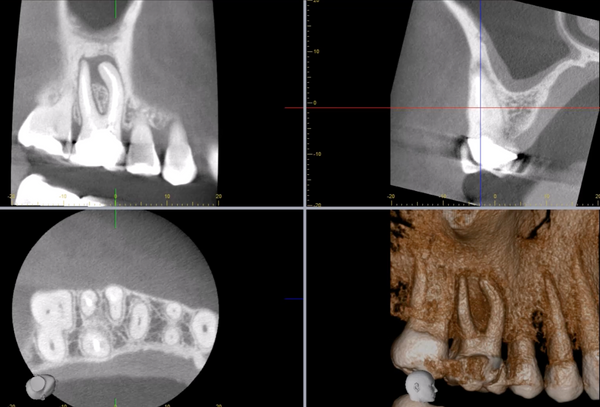 Cbct course level 1 and level 2 with emphasis on endodontics